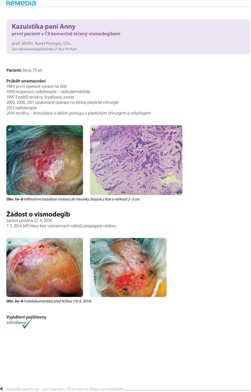 kryalizace, excize 2003, 2008, 2011 opakované operace na klinice plastické chirurgie 2013 radioterapie 2014 recidivy konzultace o dalším postupu s plastickým chirurgem a onkologem a) b) Obr.