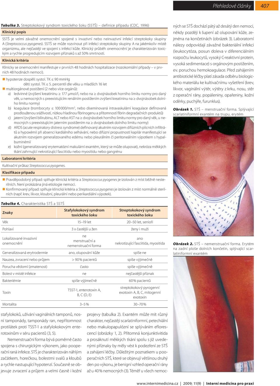 (Streptococcus pyogenes). SSTŠ se může rozvinout při infekci streptokoky skupiny A na jakémkoliv místě organizmu, ale nejčastěji ve spojení s infekcí kůže.