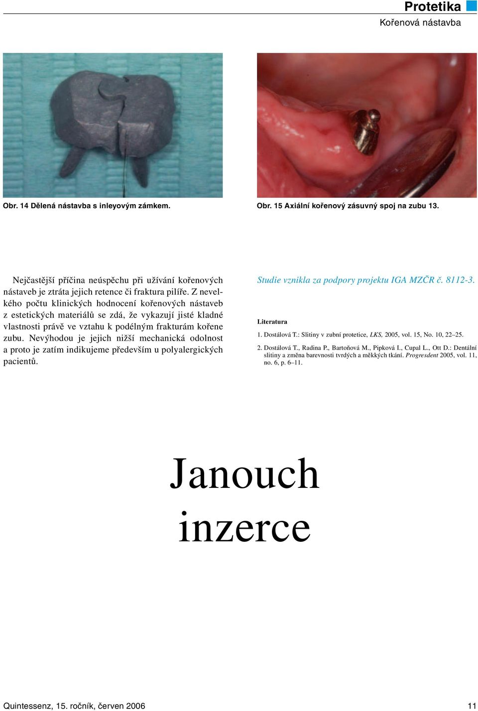 Nevýhodou je jejich nižší mechanická odolnost a proto je zatím indikujeme především u polyalergických pacientů. Studie vznikla za podpory projektu IGA MZČR č. 8112-3. Literatura 1. Dostálová T.