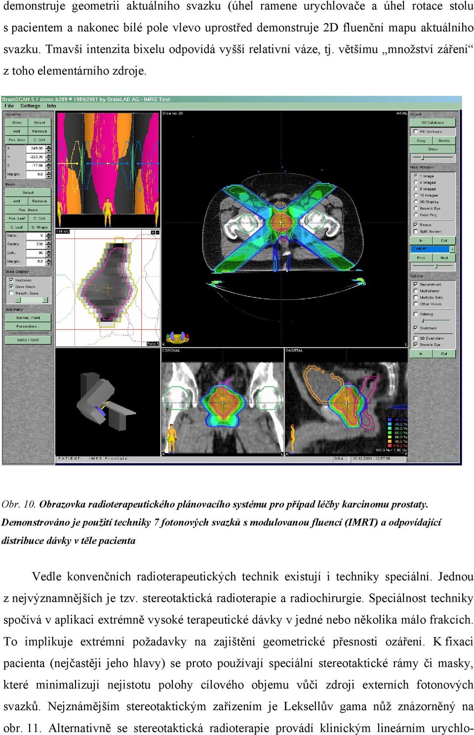 Obrazovka radioterapeutického plánovacího systému pro případ léčby karcinomu prostaty.