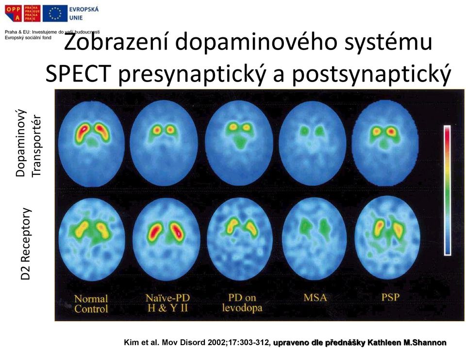 systému SPECT presynaptický a postsynaptický Kim et al.