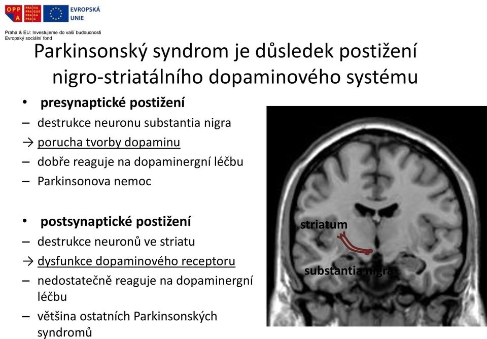 Parkinsonova nemoc postsynaptické postižení destrukce neuronů ve striatu dysfunkce dopaminového