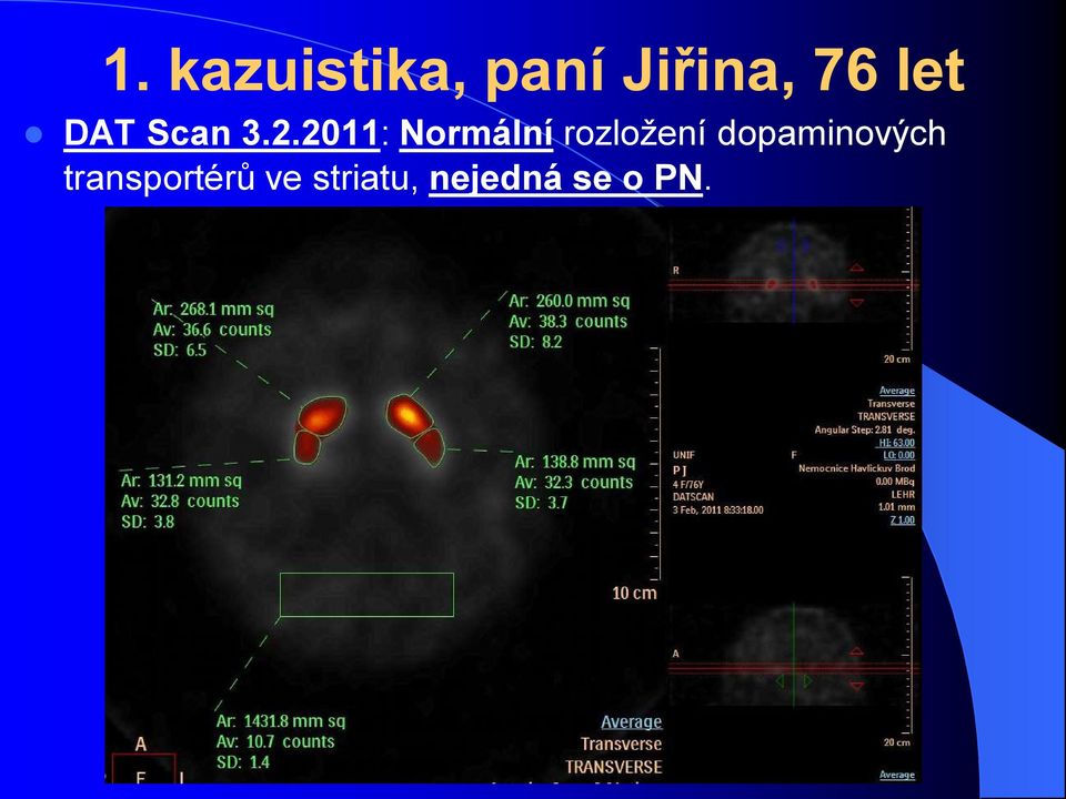 2011: Normální rozložení