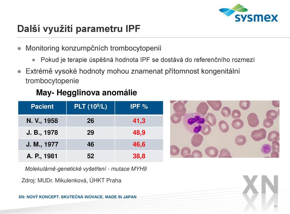 trombocytopenie May- Hegglinova anomálie Pacient PLT (109/L) IPF % N. V., 1958 26 41,3 J. B., 1978 29 48,9 J.