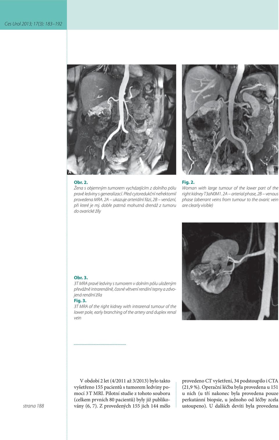 2A arterial phase, 2B venous phase (aberrant veins from tumour to the ovaric vein are clearly visible) Obr. 3.