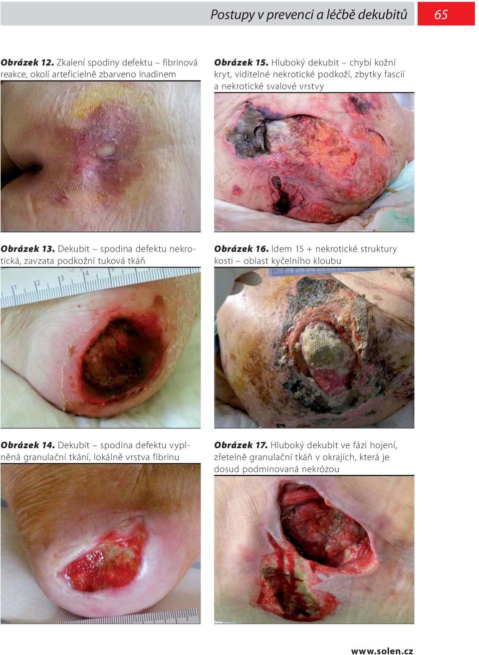 Dekubit spodina defektu nekrotická, zavzata podkožní tuková tkáň Obrázek 16. Idem 15 + nekrotické struktury kosti oblast kyčelního kloubu Obrázek 14.