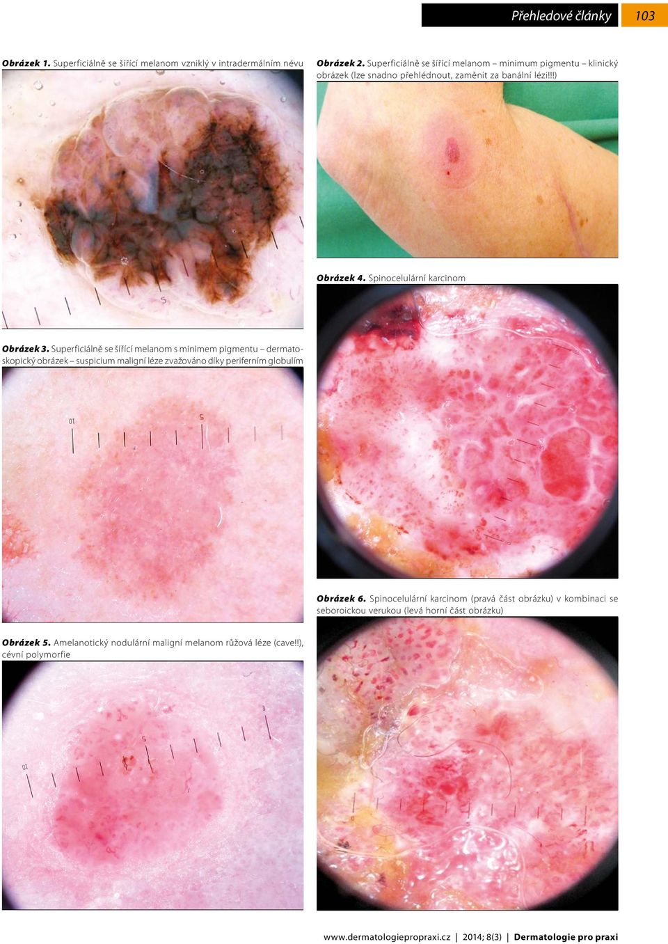 Superficiálně se šířící melanom s minimem pigmentu dermatoskopický obrázek suspicium maligní léze zvažováno díky periferním globulím Obrázek 6.