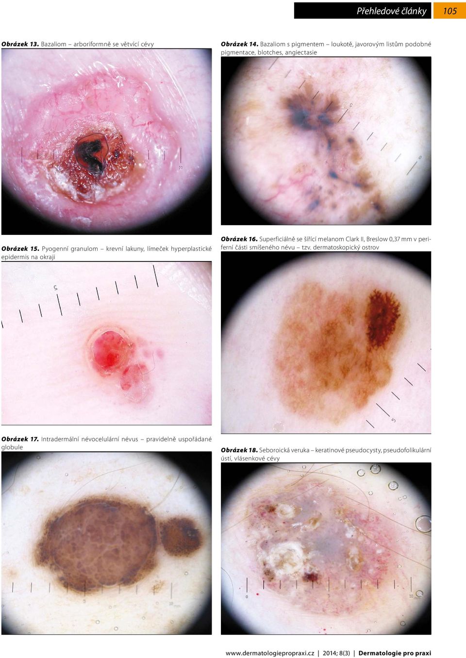 Pyogenní granulom krevní lakuny, límeček hyperplastické epidermis na okraji Obrázek 16.