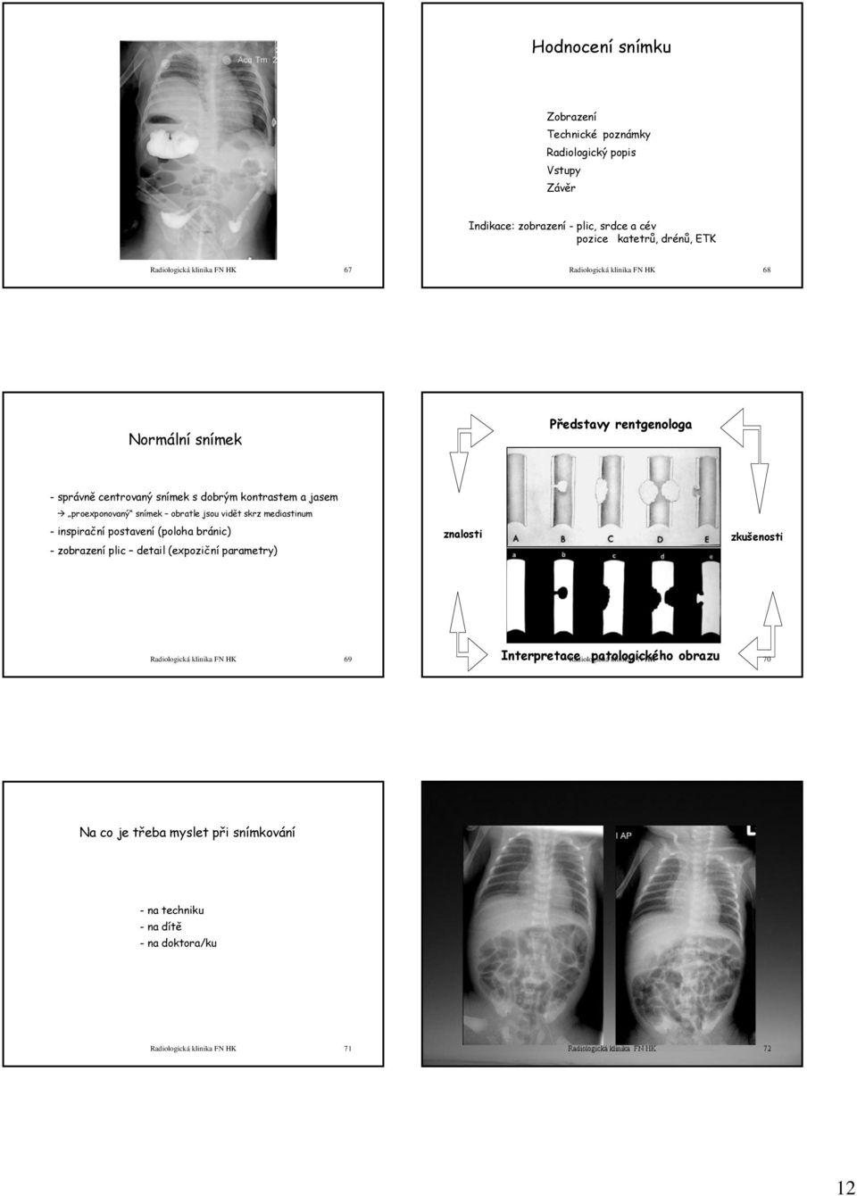mediastinum -inspirační postavení (poloha bránic) - zobrazení plic detail (expoziční parametry) znalosti zkušenosti Radiologická klinika FN HK 69 Interpretace Radiologická