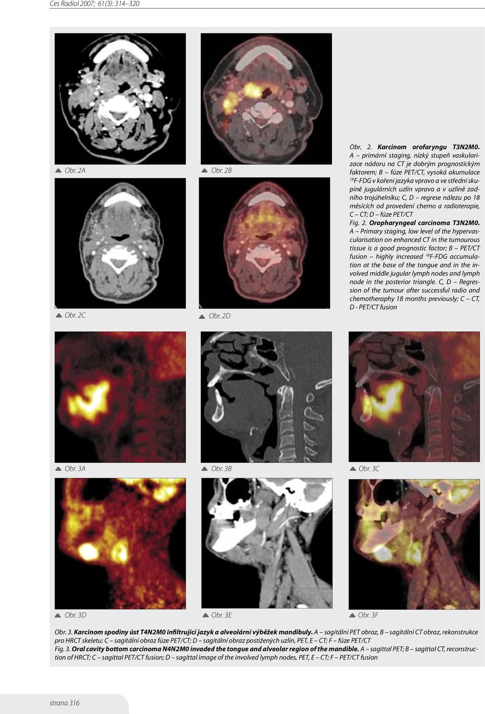 vpravo a v uzlině zadního trojúhelníku; C, D regrese nálezu po měsících od provedení chemo a radioterapie, C CT; D fúze PET/CT Fig. 2. Oropharyngeal carcinoma T3N2M0.