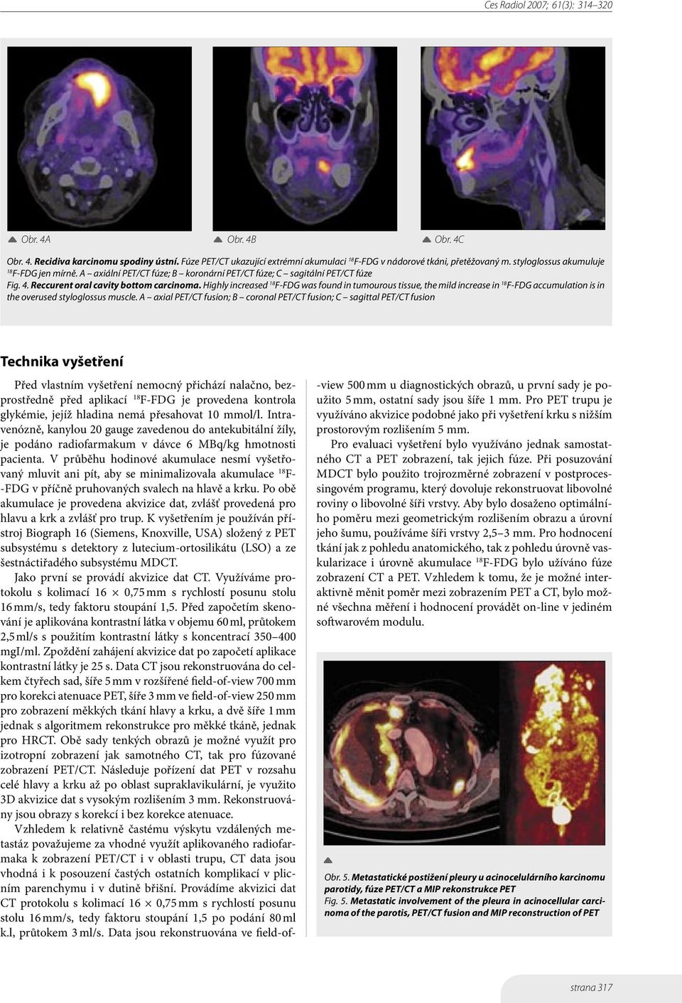 Highly increased F-FDG was found in tumourous tissue, the mild increase in F-FDG accumulation is in the overused styloglossus muscle.