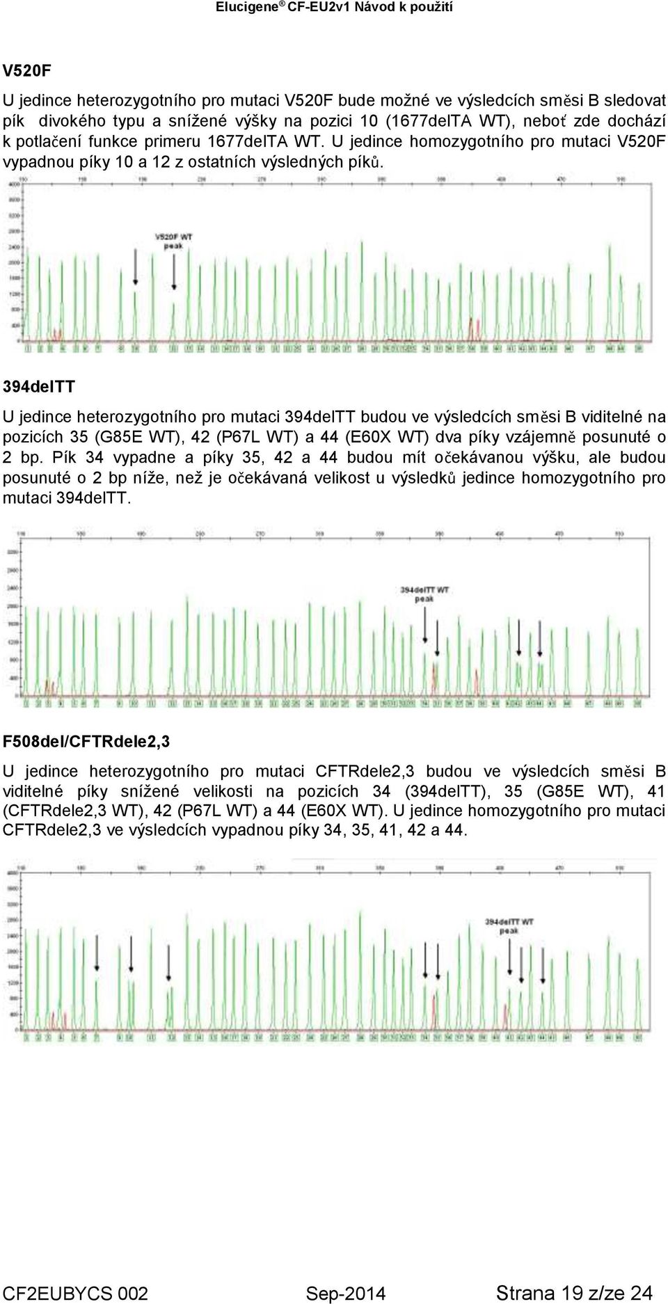 394delTT U jedince heterozygotního pro mutaci 394delTT budou ve výsledcích směsi B viditelné na pozicích 35 (G85E WT), 42 (P67L WT) a 44 (E60X WT) dva píky vzájemně posunuté o 2 bp.