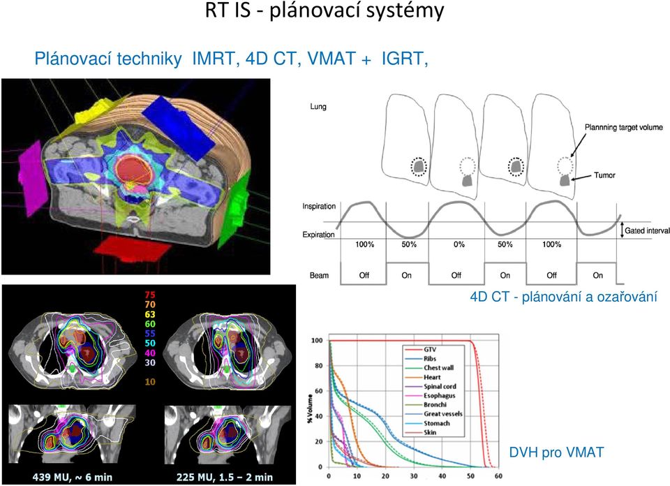 CT, VMAT + IGRT, 4D CT -