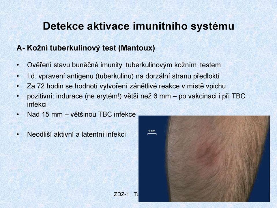 vpravení antigenu (tuberkulinu) na dorzální stranu předloktí Za 72 hodin se hodnotí vytvoření zánětlivé