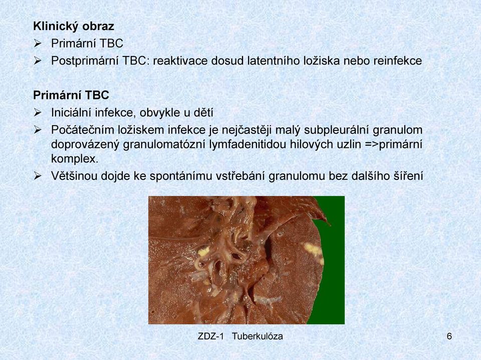 nejčastěji malý subpleurální granulom doprovázený granulomatózní lymfadenitidou hilových uzlin