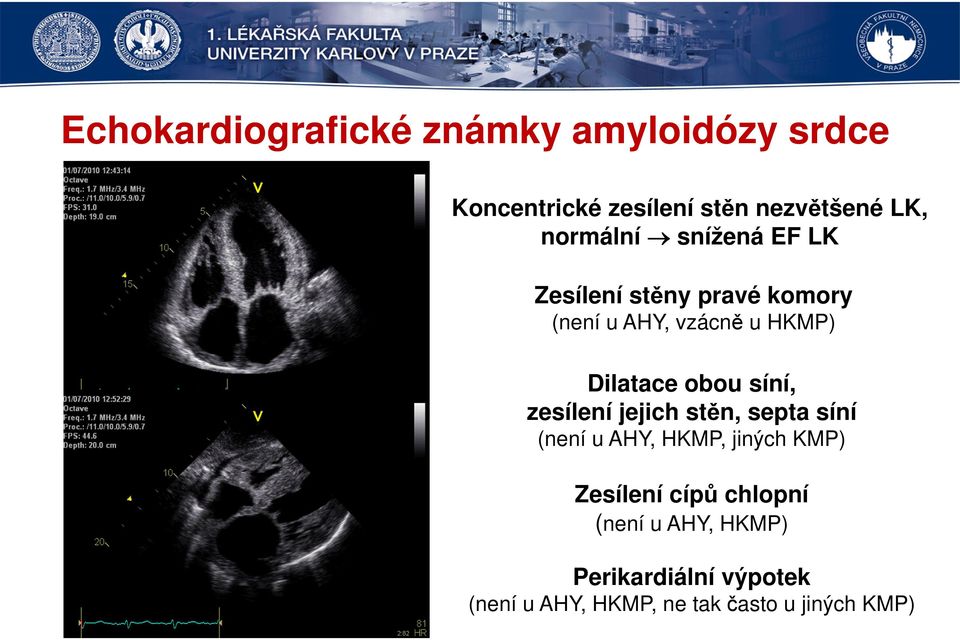 obou síní, zesílení jejich stěn, septa síní (není u AHY, HKMP, jiných KMP) Zesílení cípů