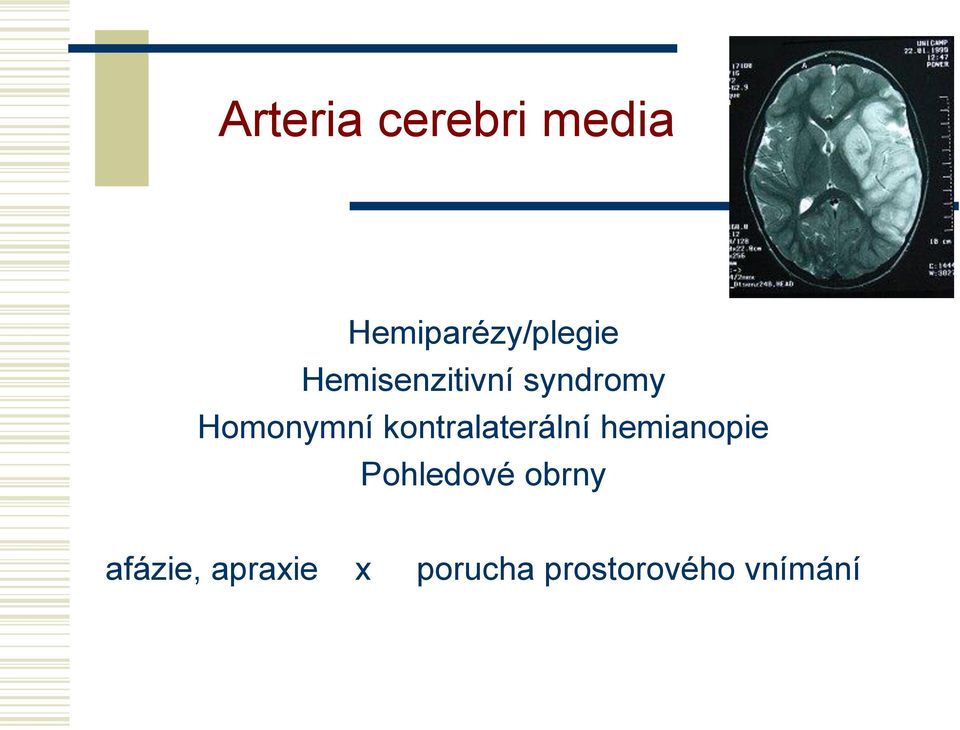 kontralaterální hemianopie Pohledové