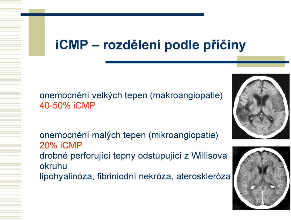 (mikroangiopatie) 20% icmp drobné perforující tepny