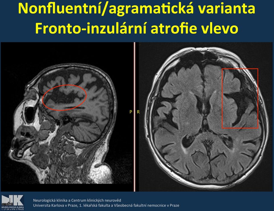 klinických neurověd Universita Karlova v Praze, 1.