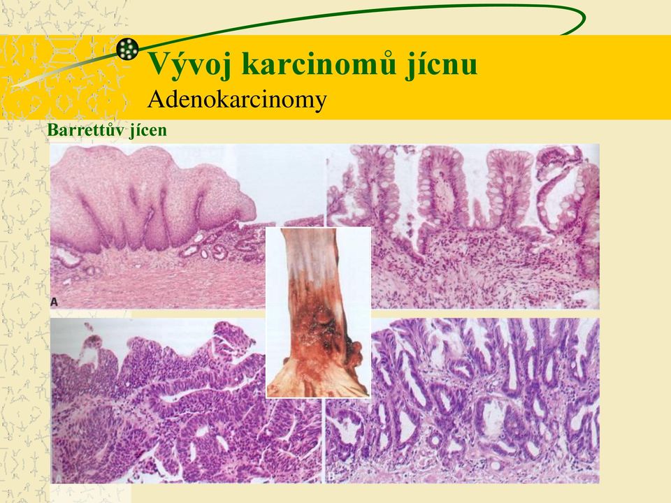 karcinomů