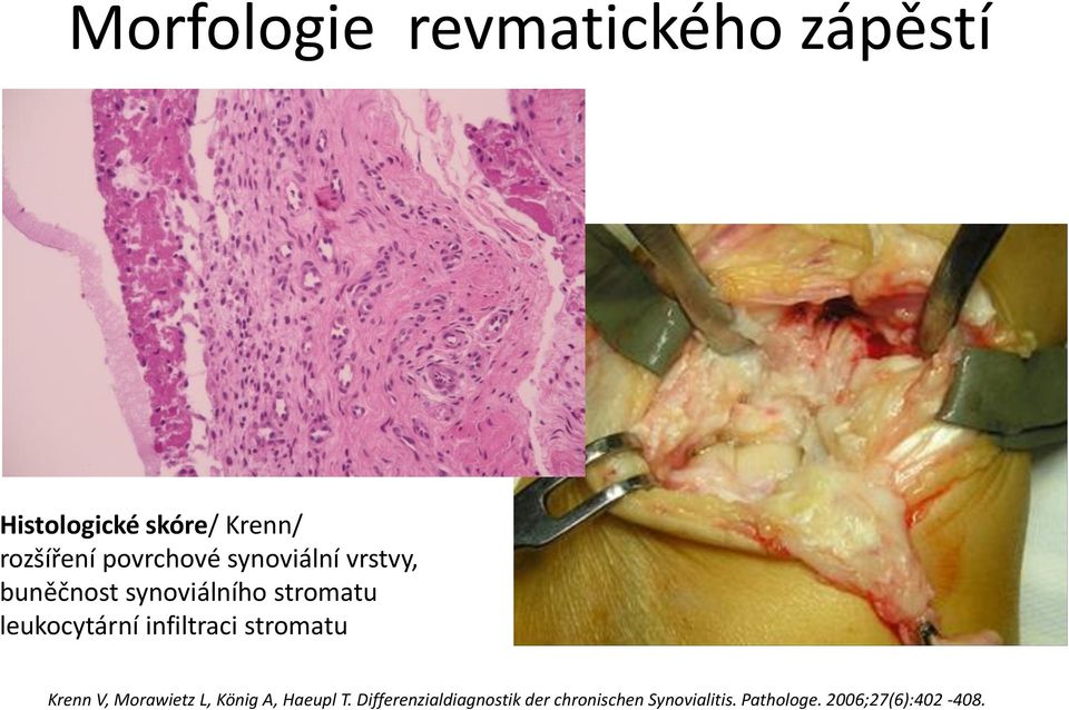 leukocytární infiltraci stromatu Krenn V, Morawietz L, König A, Haeupl