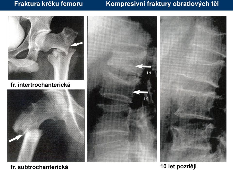 obratlových těl fr.