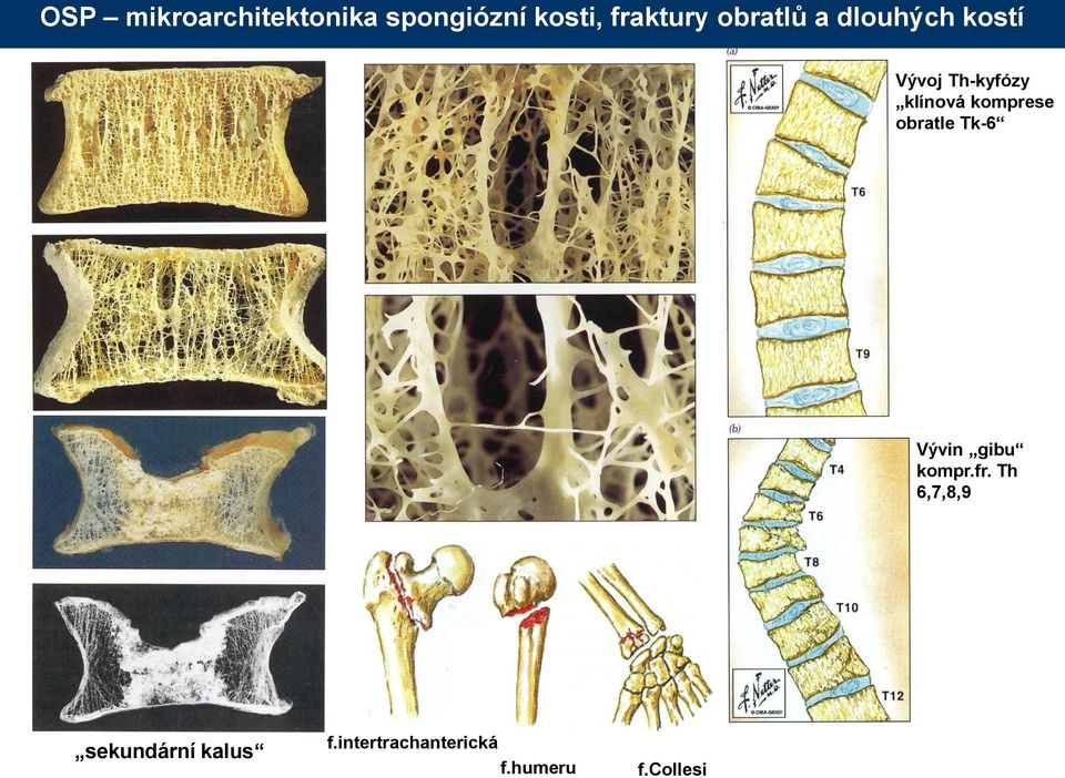 komprese obratle Tk-6 Vývin gibu kompr.fr.