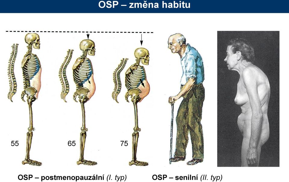 postmenopauzální (I.