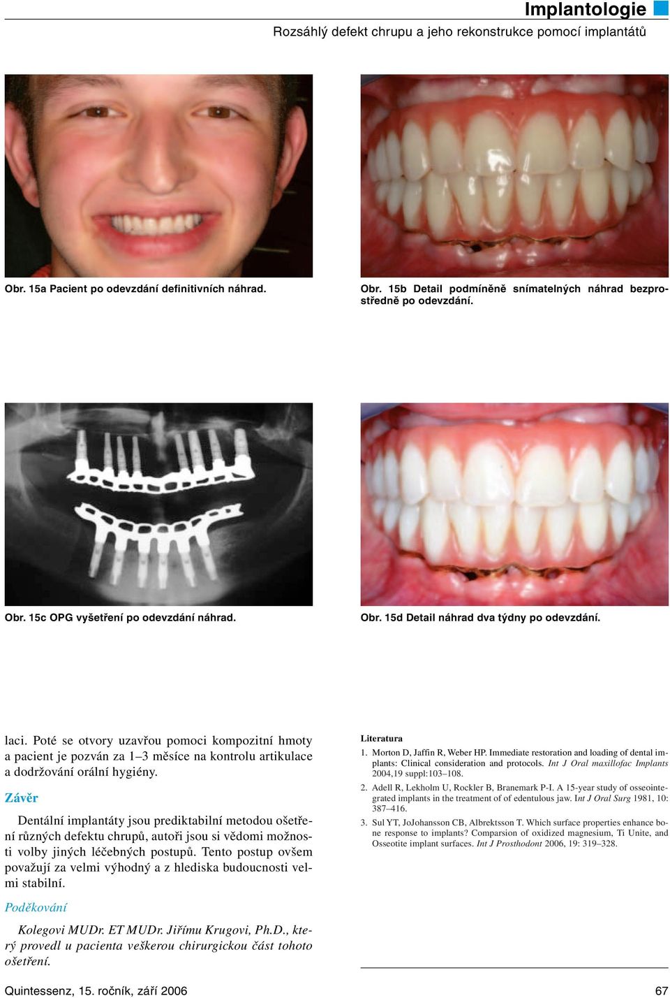 Závěr Dentální implantáty jsou prediktabilní metodou ošetření různých defektu chrupů, autoři jsou si vědomi možnosti volby jiných léčebných postupů.