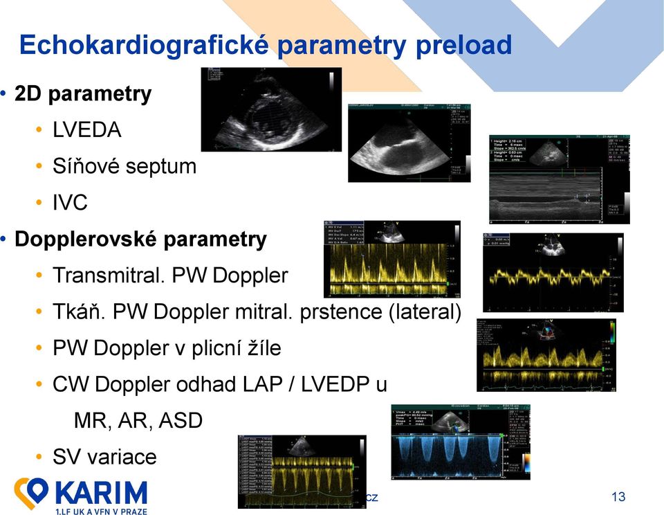 PW Doppler Tkáň. PW Doppler mitral.