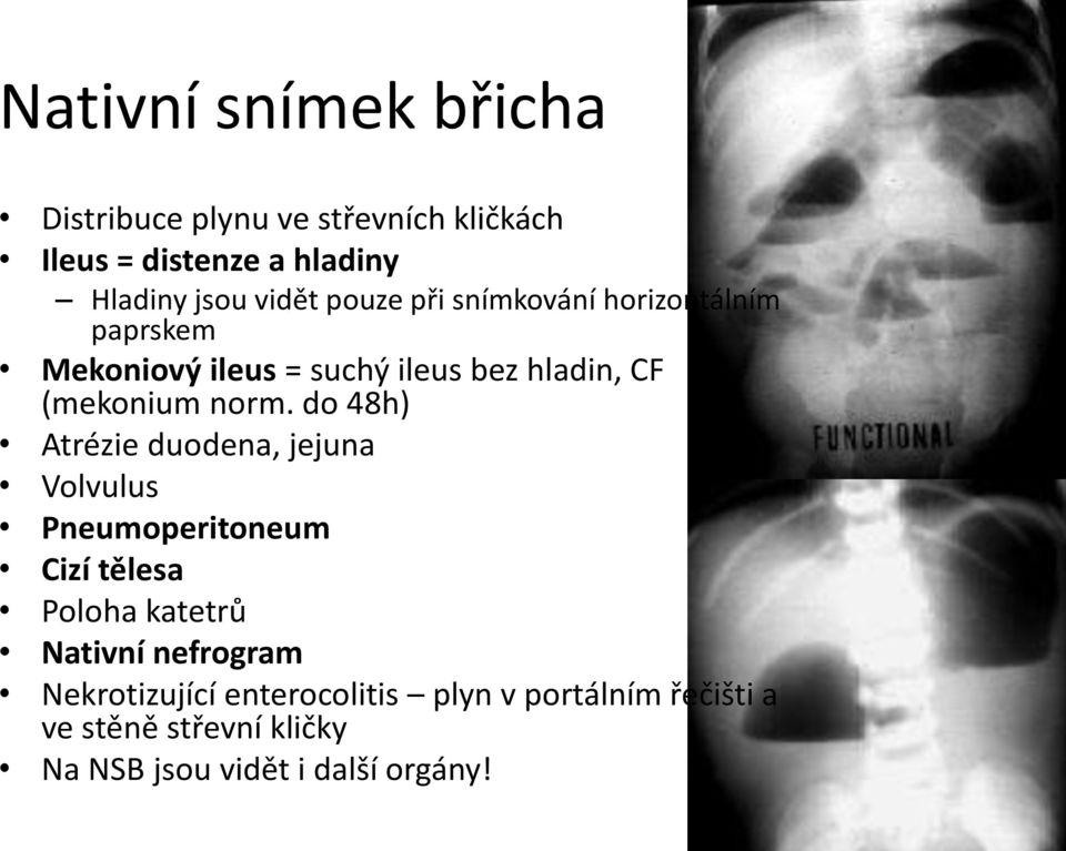 do 48h) Atrézie duodena, jejuna Volvulus Pneumoperitoneum Cizí tělesa Poloha katetrů Nativní nefrogram