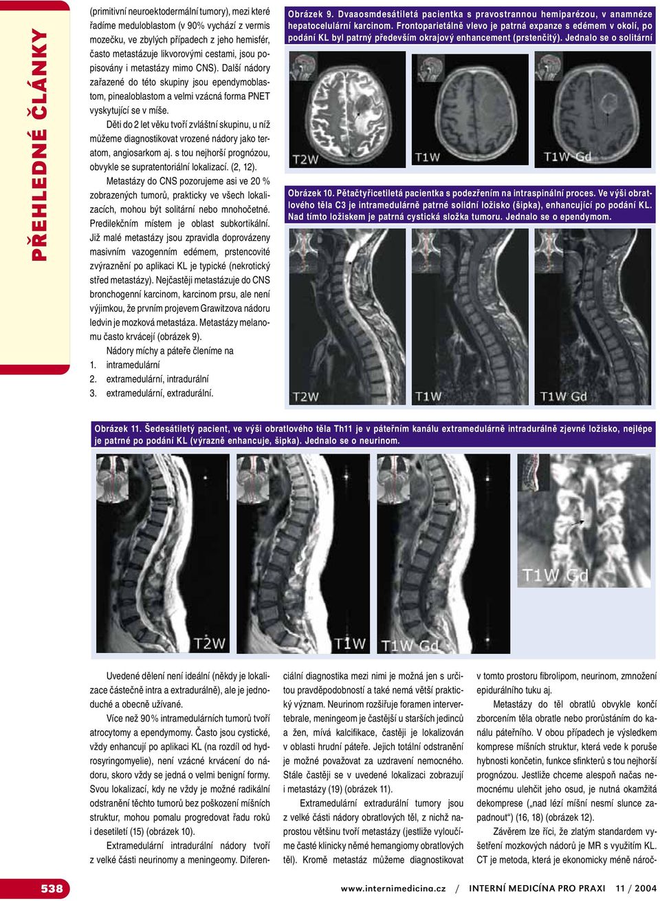 Děti do 2 let věku tvoří zvláštní skupinu, u níž můžeme diagnostikovat vrozené nádory jako teratom, angiosarkom aj. s tou nejhorší prognózou, obvykle se supratentoriální lokalizací. (2, 12).