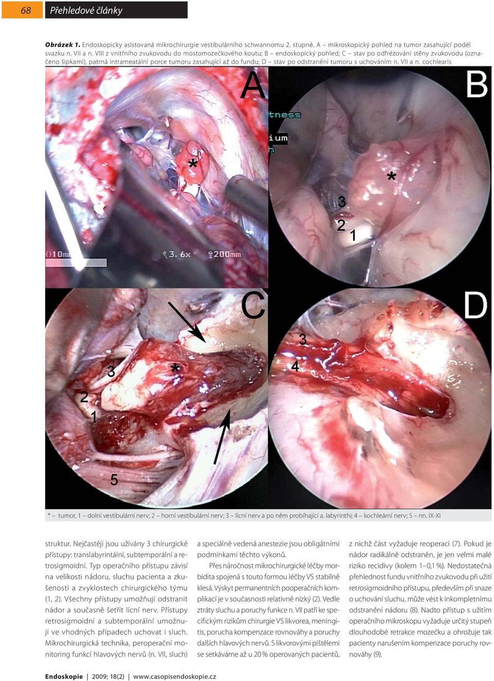 po odstranění tumoru s uchováním n. VII a n. cochlearis * tumor, 1 dolní vestibulární nerv; 2 horní vestibulární nerv; 3 lícní nerv a po něm probíhající a. labyrinthi; 4 kochleární nerv; 5 nn.