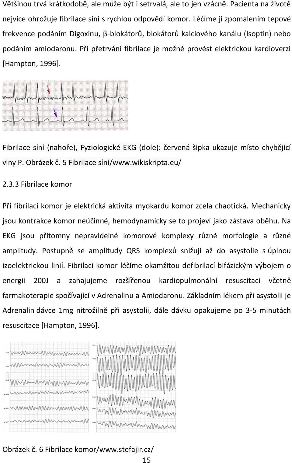 Při přetrvání fibrilace je možné provést elektrickou kardioverzi [Hampton, 1996]. Fibrilace síní (nahoře), Fyziologické EKG (dole): červená šipka ukazuje místo chybějící vlny P. Obrázek č.