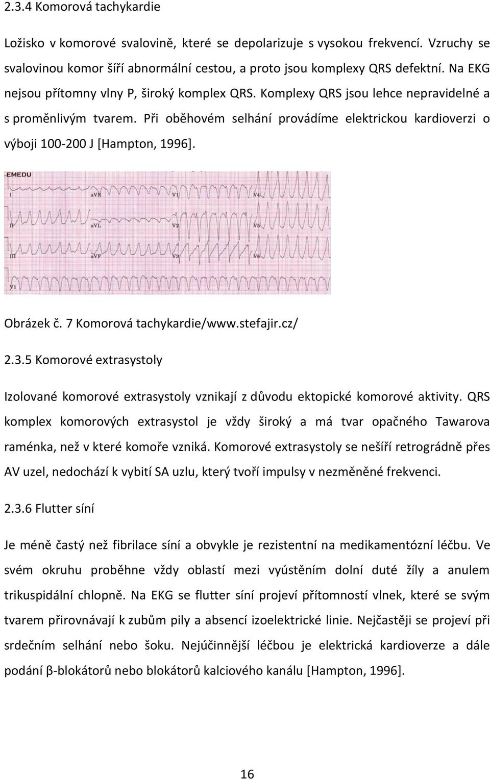 Při oběhovém selhání provádíme elektrickou kardioverzi o výboji 100-200 J [Hampton, 1996]. Obrázek č. 7 Komorová tachykardie/www.stefajir.cz/ 2.3.