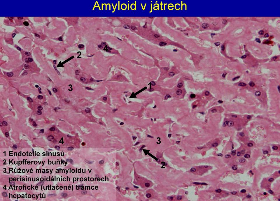 amyloidu v perisinusoidálních prostorech