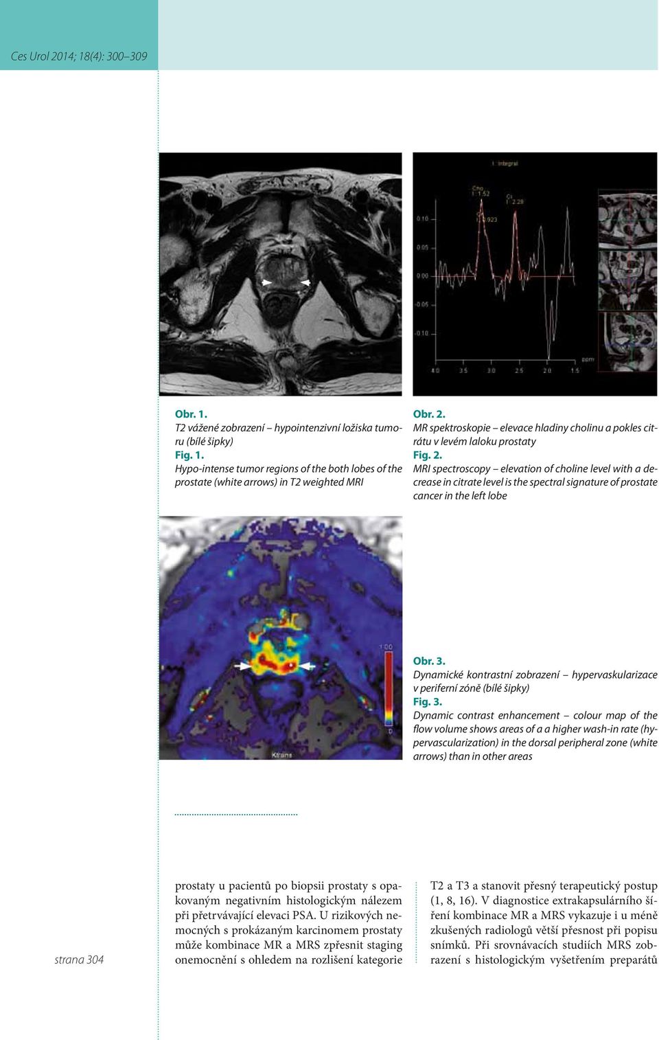 MRI spectroscopy elevation of choline level with a decrease in citrate level is the spectral signature of prostate cancer in the left lobe Obr. 3.