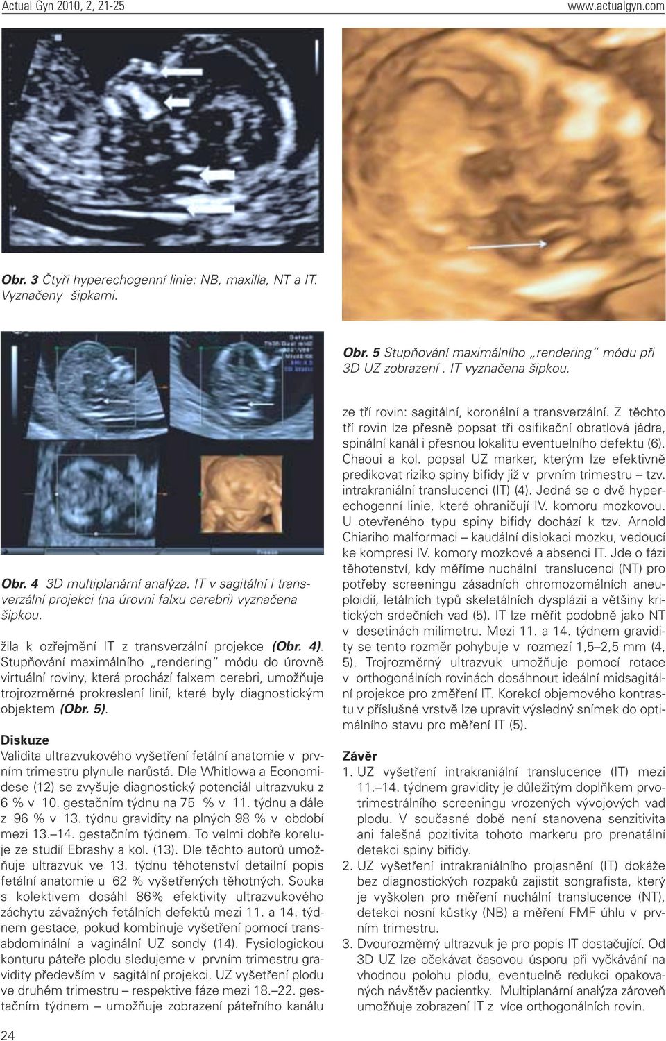 Stupňování maximálního rendering módu do úrovně virtuální roviny, která prochází falxem cerebri, umožňuje trojrozměrné prokreslení linií, které byly diagnostickým objektem (Obr. 5).