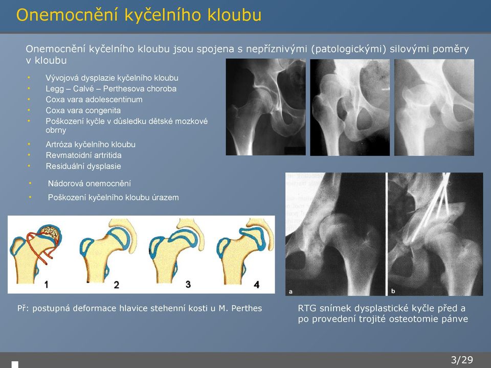 mozkové obrny Artróza kyčelního kloubu Revmatoidní artritida Residuální dysplasie Nádorová onemocnění Poškození kyčelního kloubu úrazem