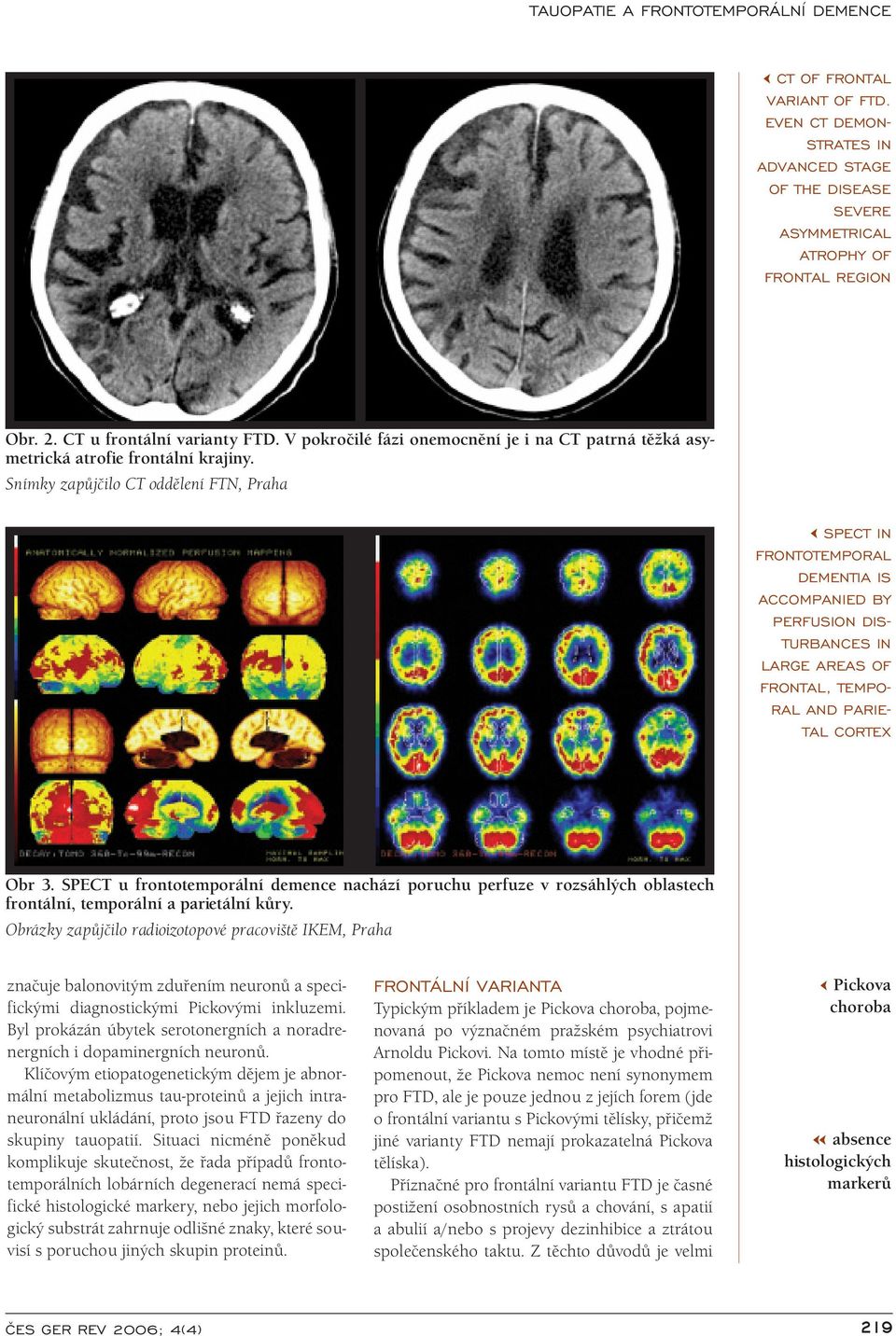 Snímky zapůjčilo CT oddělení FTN, Praha SPECT IN FRONTOTEMPORAL DEMENTIA IS ACCOMPANIED BY PERFUSION DIS TURBANCES IN LARGE AREAS OF FRONTAL, TEMPO RAL AND PARIE TAL CORTEX Obr 3.