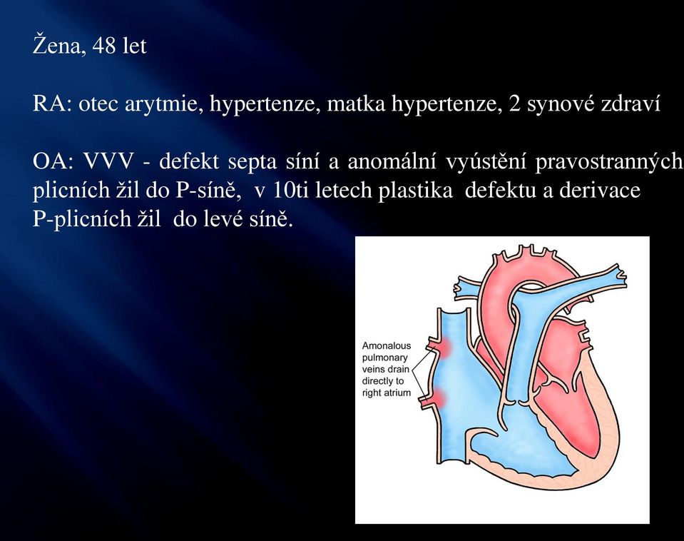 anomální vyústění pravostranných plicních žil do P-síně, v