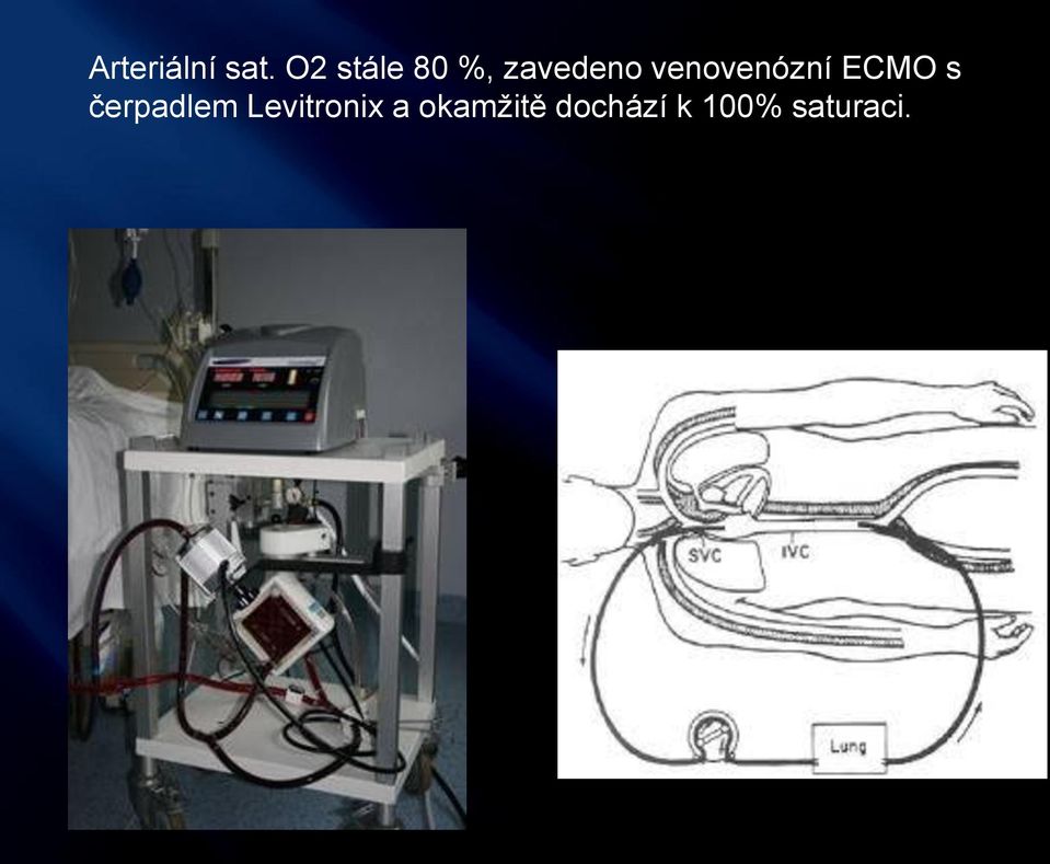 venovenózní ECMO s čerpadlem