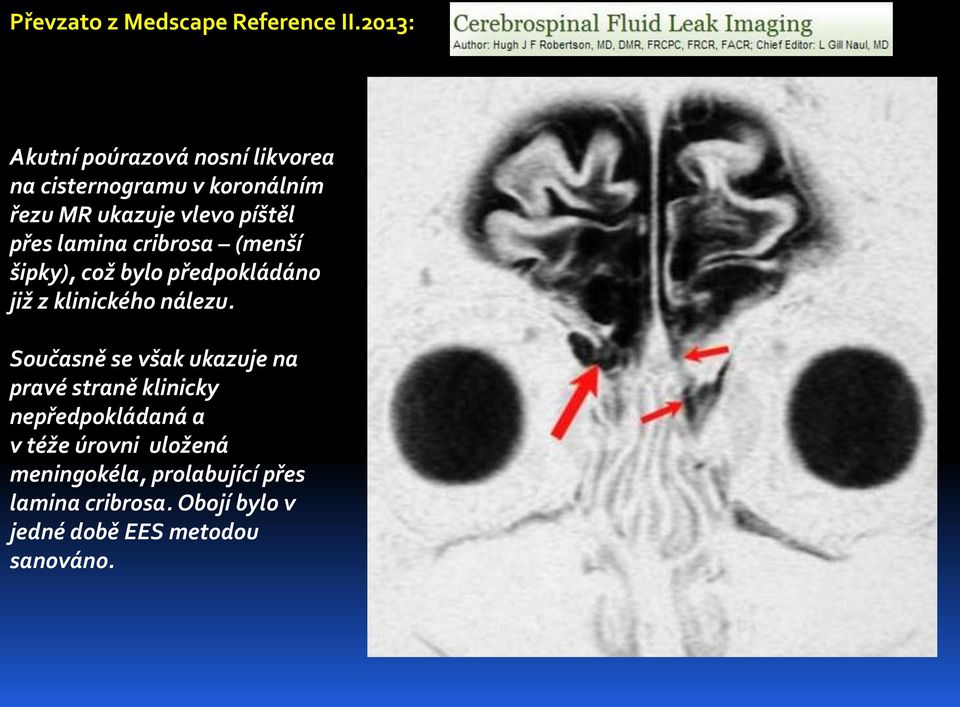přes lamina cribrosa (menší šipky), což bylo předpokládáno již z klinického nálezu.
