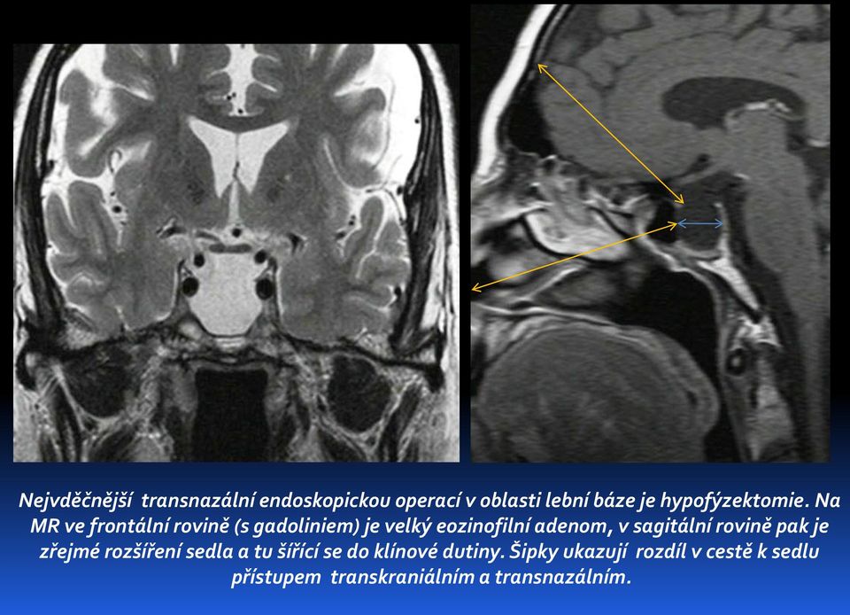 Na MR ve frontální rovině (s gadoliniem) je velký eozinofilní adenom, v