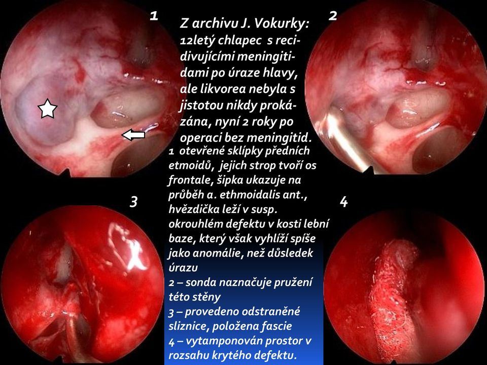 operaci bez meningitid. 1 otevřené sklípky předních etmoidů, jejich strop tvoří os frontale, šipka ukazuje na průběh a. ethmoidalis ant.