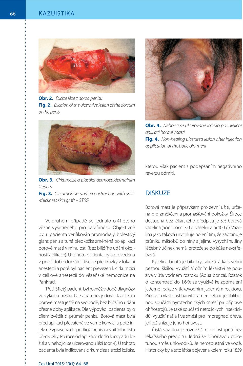 Circumcision and reconstruction with split- -thickness skin graft STSG Ve druhém případě se jednalo o 41letého vězně vyšetřeného pro parafimózu.