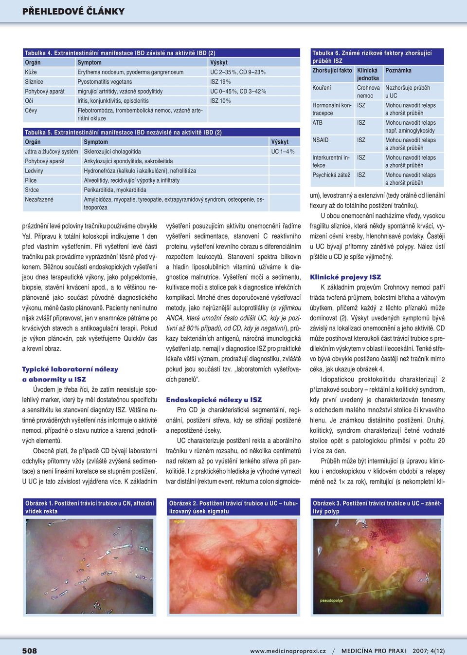 aparát migrující artritidy, vzácně spodylitidy UC 0 45 %, CD 3 42 % Oči Iritis, konjunktivitis, episcleritis ISZ 10 % Cévy Flebotrombóza, trombembolická nemoc, vzácně arteriální okluze Tabulka 5.