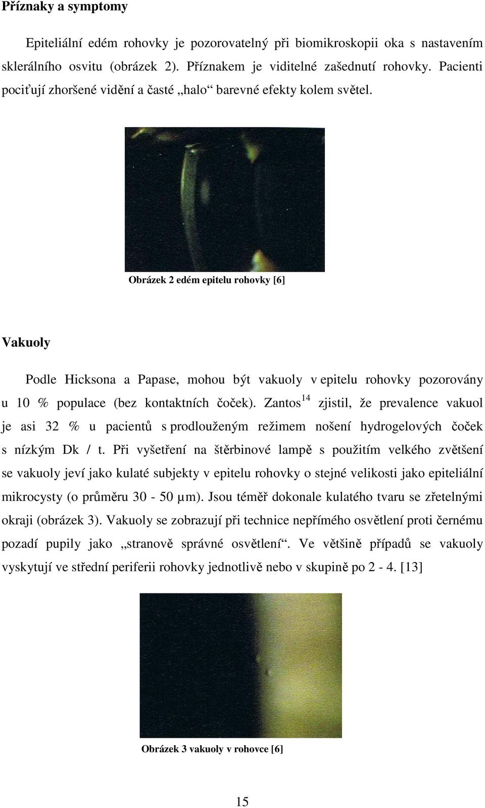 Obrázek 2 edém epitelu rohovky [6] Vakuoly Podle Hicksona a Papase, mohou být vakuoly v epitelu rohovky pozorovány u 10 % populace (bez kontaktních čoček).