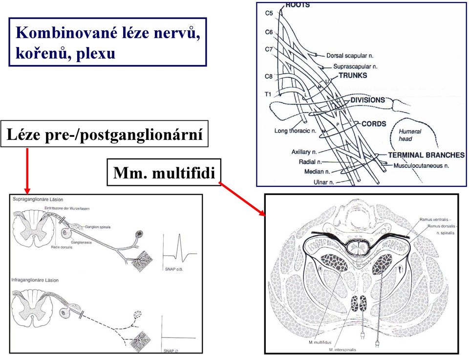 plexu Léze