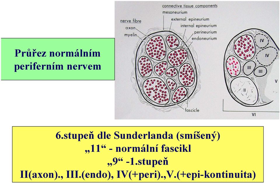 normální fascikl 9-1.stupeň II(axon).